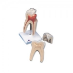 상악 대구치, 3-파트 Upper Triple-Root Molar, 3 part D10/5