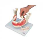 2배 확대 치아질환모형, 21 파트 분리 Dental disease, magnified 2 times, 21 parts D26