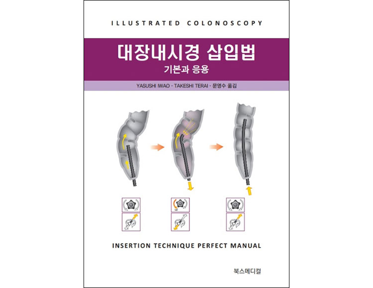 대장내시경 삽입법