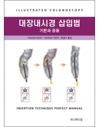 대장내시경 삽입법