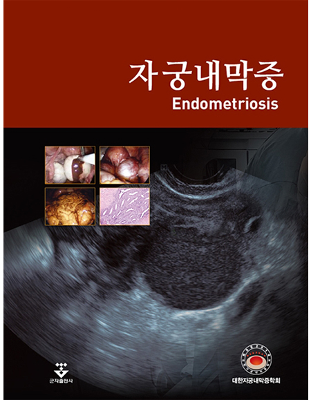 자궁내막증 _군자출판사