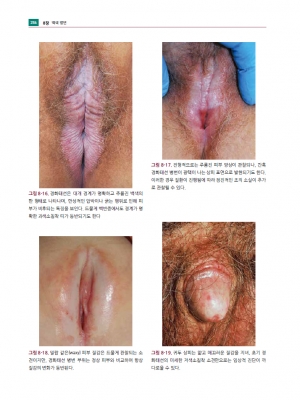 생식기 피부질환 진료지침 4판_가본의학