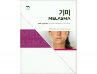 기미 (Melasma) _엠디월드