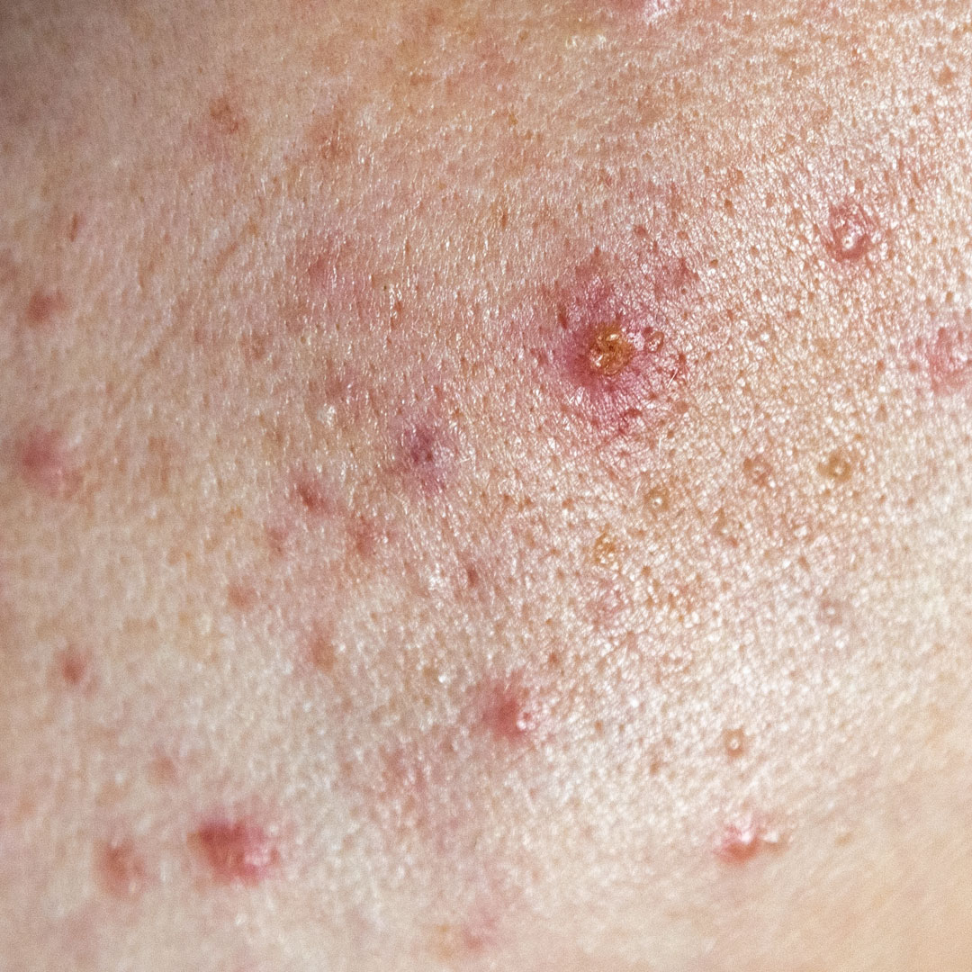 레티놀이 여드름에 정말 효과가 있을까?