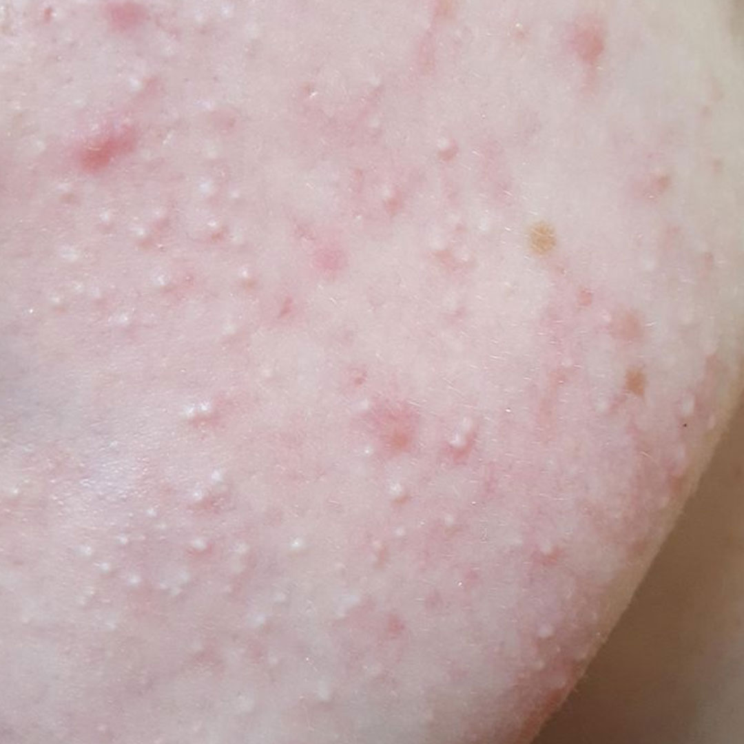 여름철 땀 흘리고 나서 뾰루지처럼 올라오나요? 혹시 모낭염일 수 있어요