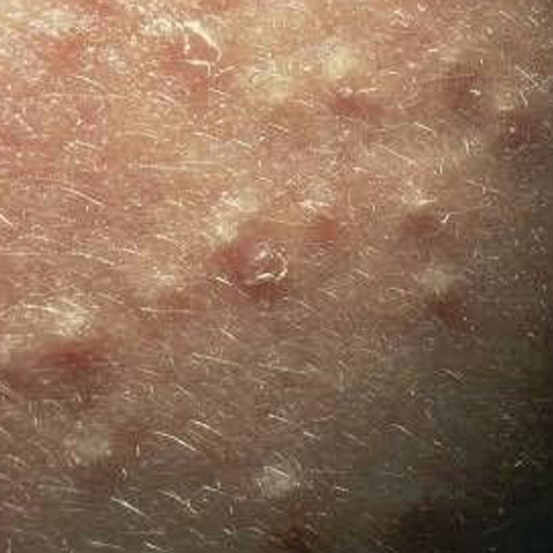 좁쌀여드름 없애는 루틴｜10대·20대·30대·40대별 맞춤 관리법