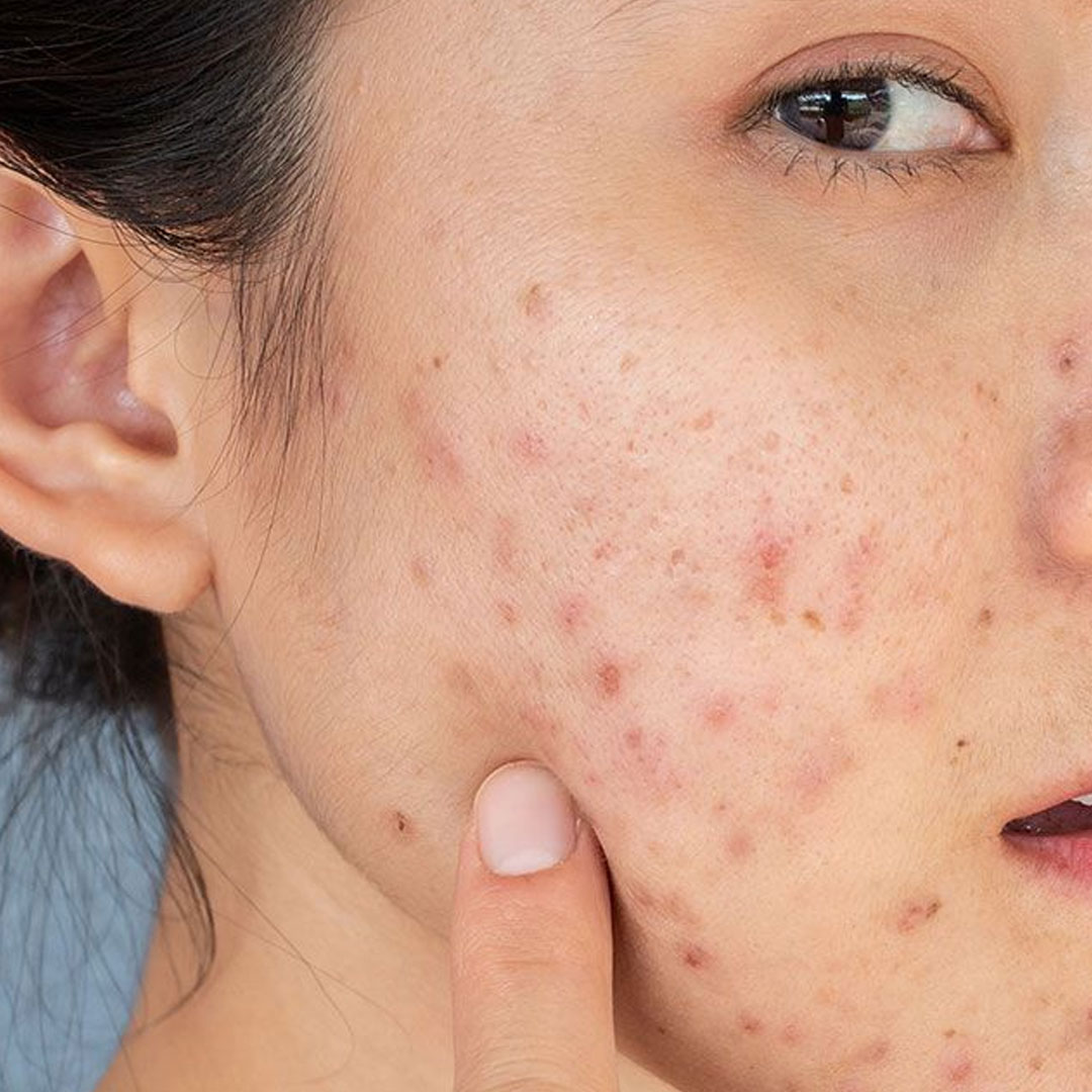 여드름흉터 없애는 법｜피부과 치료가 필요한 흉터 vs 화장품으로 가능한 자국