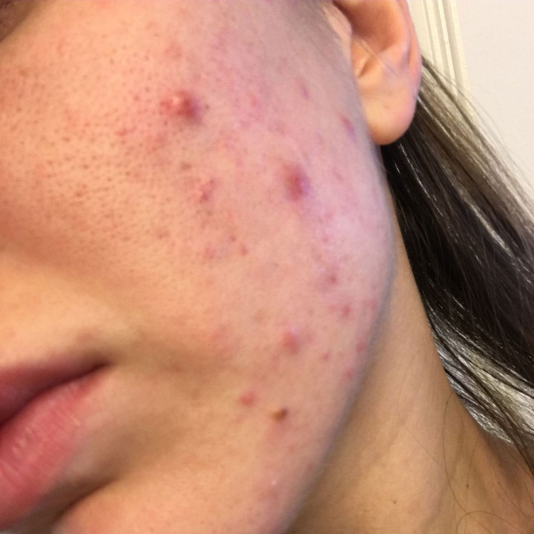 성인여드름 치료 순서｜피부과 시술부터 스킨케어까지