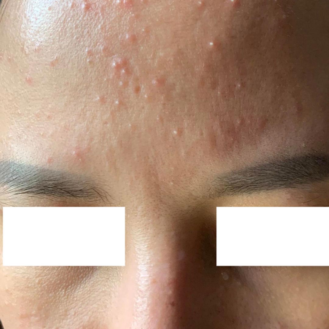 여드름인 줄 알았는데 모낭염 — 종류별 원인·치료·홈케어 완전 정리
