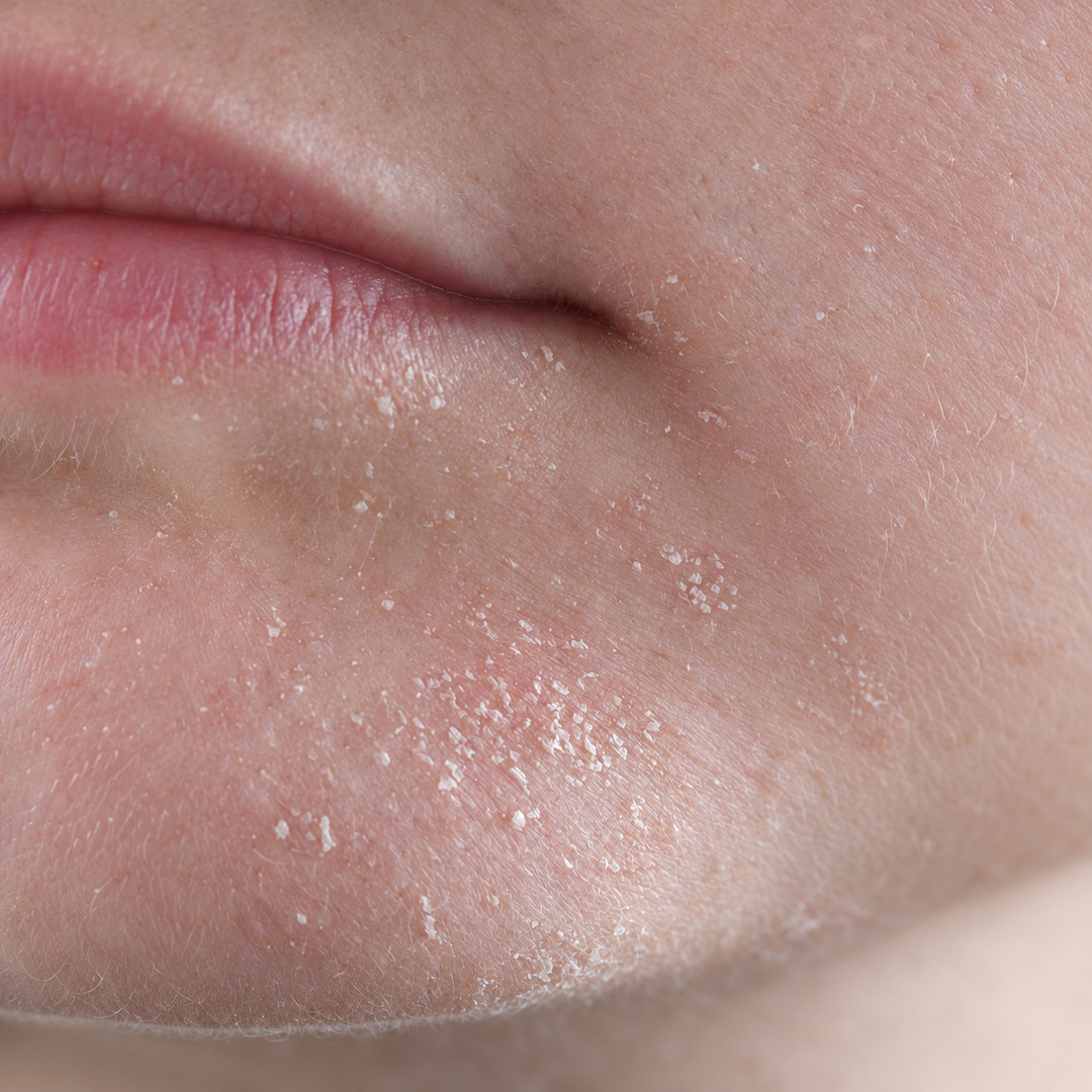 하얀 각질이 계속 일어난다면? 필링보다 보습이 먼저일까?