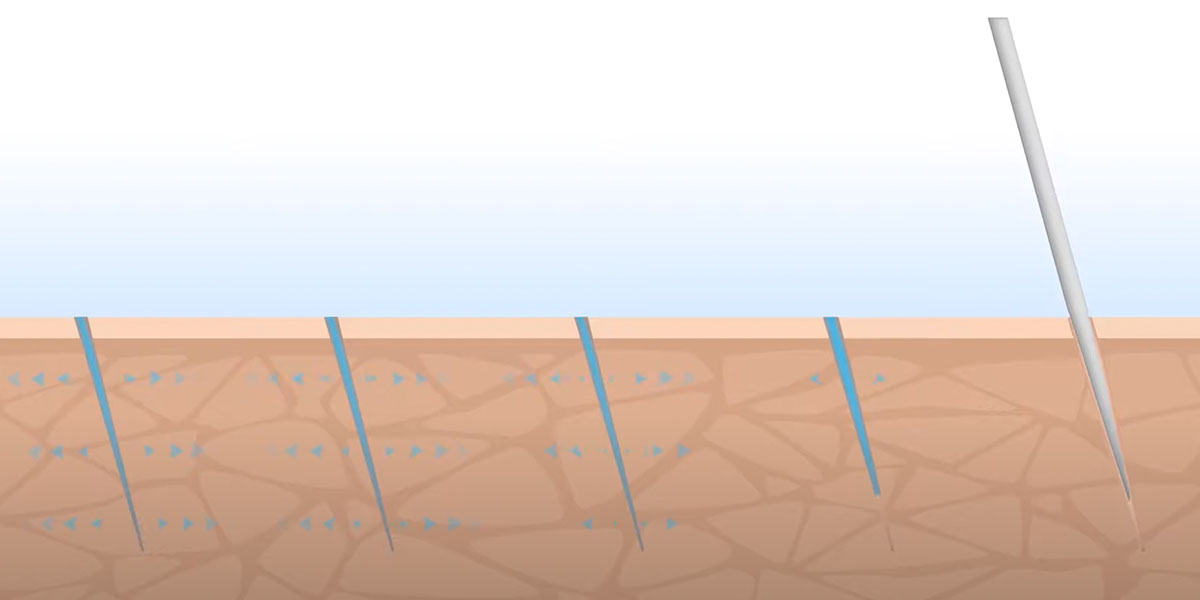 microned_5_145514.jpg