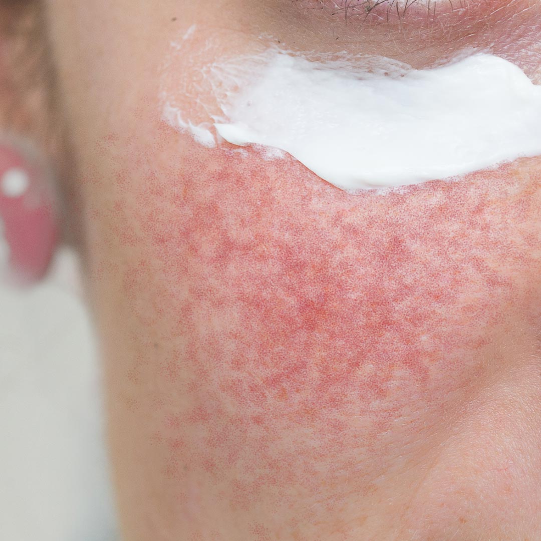 안면홍조 원인과 해결방법 | 손상된 피부 장벽 복구 강화가 핵심