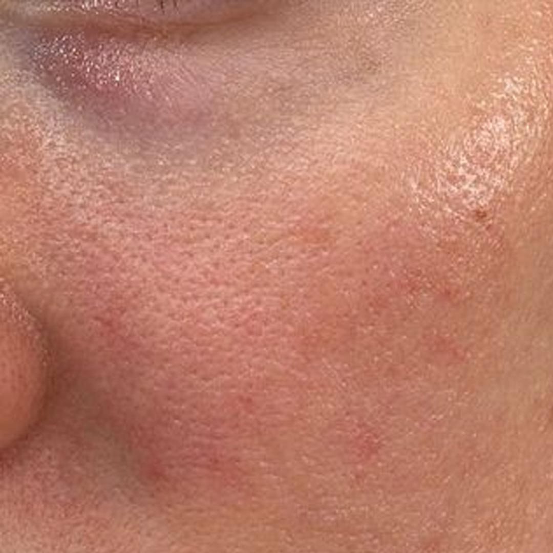 화장품 바르면 따가운 이유? 피부가 예민해진 걸까요