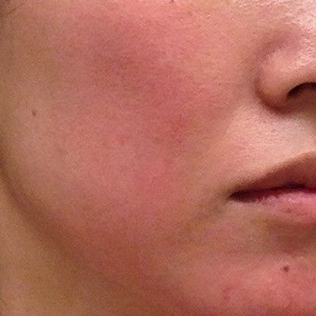 안면홍조 치료에 바르는 로자트롤