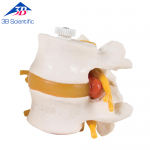 3B Scientific 요추 모형/요추 디스크 탈출 모형 , A76/9, 2 Lumbar Vertebrae with prolapsed disc, flexibly mounted