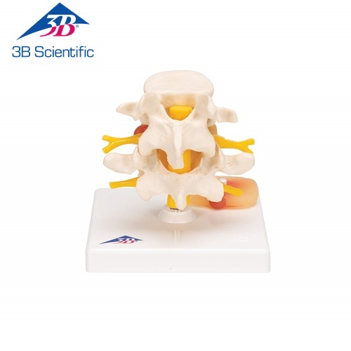 3B Scientific 추간판 탈출증이 있는 요추 모형 A76 [1000149]