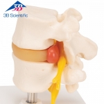 3B Scientific 추간판 탈출증이 있는 요추 모형 A76 [1000149]