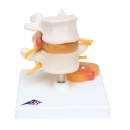 추간판 탈출증이 있는 요추 인체 모형