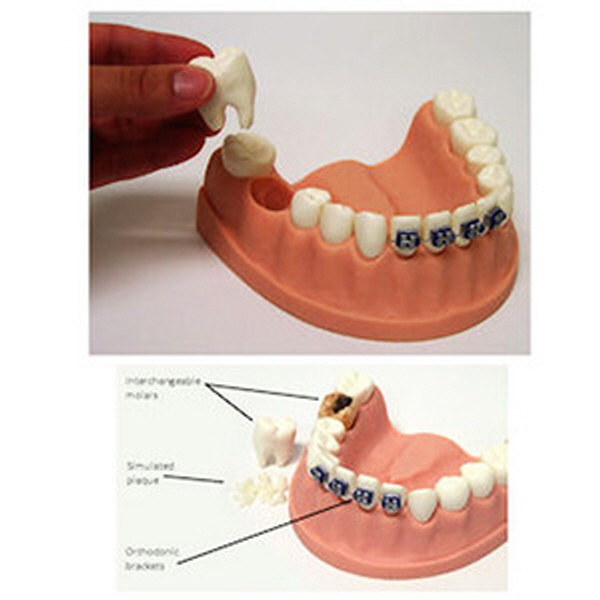 [사회보건] 치아관리 모형 (비만교육/사회보건 교육)