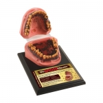 [금연교육] Mr. Gross Mouth (M79152KO) / 치육염과 암종이 발생한 입안 관찰