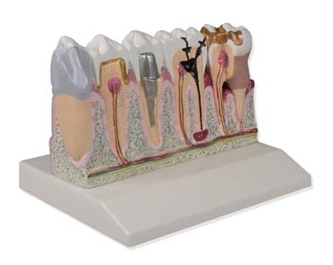 치아모형 (D250) / 실제 치아 4배 크기 / 치아 변색, 충치, 염증, 감염, 치주질환 관찰 / 치아질환 및 치료솔루션 모형